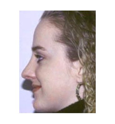 Open Tip Rhinoplasty After